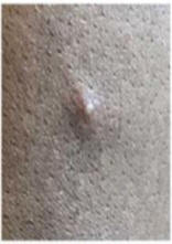 Small pustule, 2mm diameter, Individual Monkeypox Skin Lesions close-up