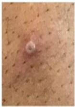 Umbilicated pustule, 3-4mm diameter, Individual Monkeypox Skin Lesions close-up
