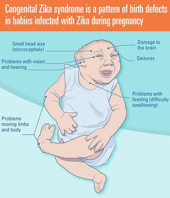 Photo of Congenital Zika Syndrome